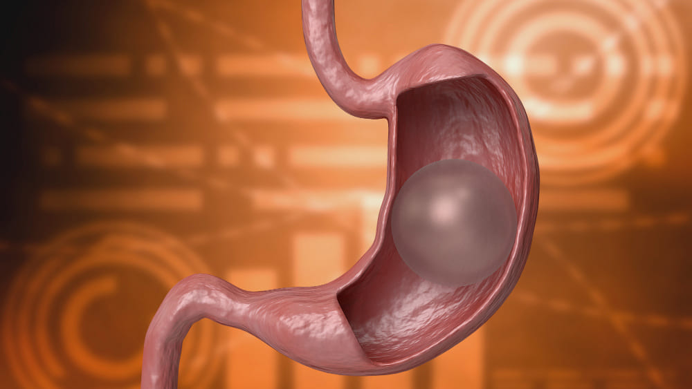 Colocación de balón intragástrico en CDMX